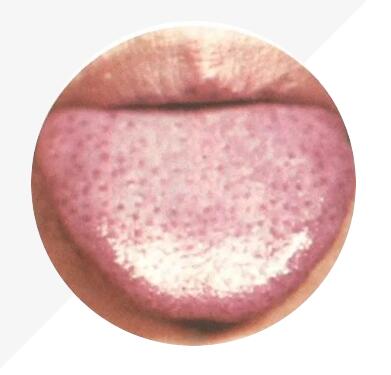 玄兀古法舌診參考--舌形和舌面(miàn)大小厚度顔色
