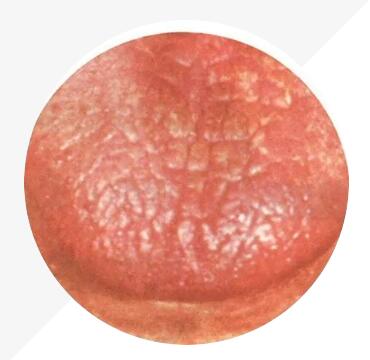 玄兀古法舌診參考--瘀血體質典型舌象